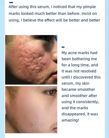 Salicylic Acid  Solution Essence Shrink pores and Acne Spot Removing Shrink Pores Oil-Control Brighten Face Skin Makeup